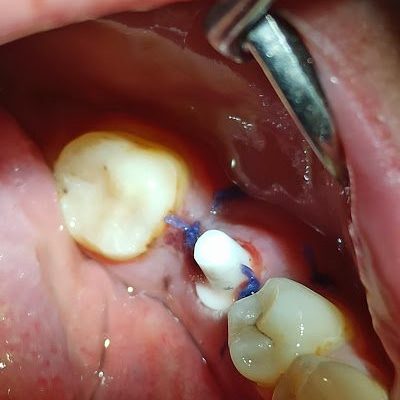 Diş çekimi ve hemen ardından uygulanan seramik implant...