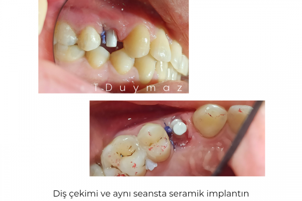 seramik implant