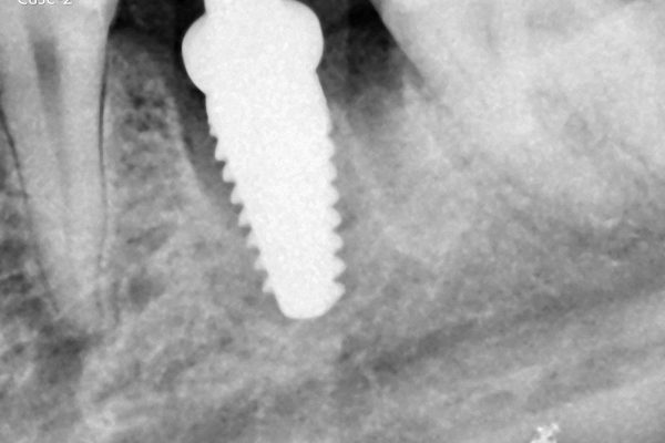 Case-2 | Panoramic X-Ray After Ceramic (Zirconia) Implant Placement