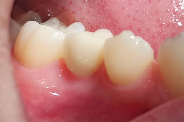 Ceramic implant with completed crown